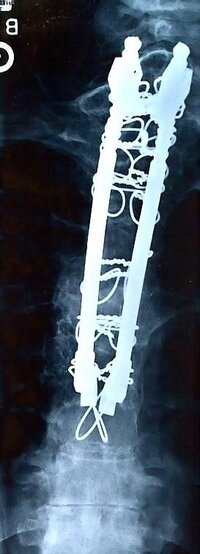 Xray