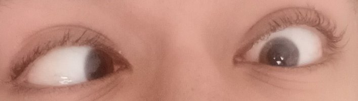 Left eye when fully relaxed with Atropine 1% sulfate drops.jpg