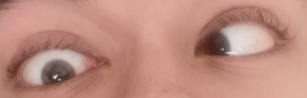Right eye when fully relaxed with Atropine 1% sulfate drops.jpg