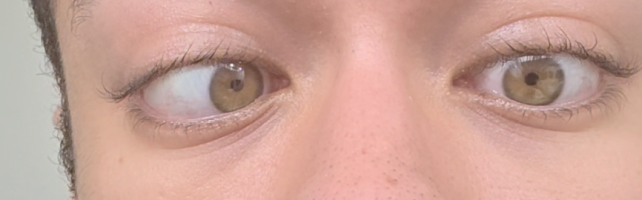 Left eye when fully relaxed off Atropine.png