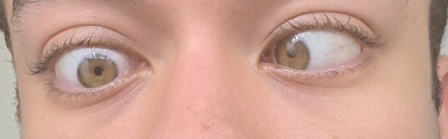 Right eye when fully relaxed off Atropine.png