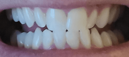 Teeth 1 Teeth 1