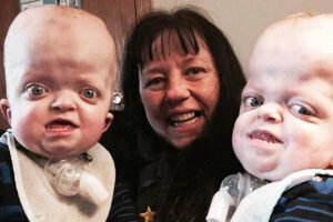 Sindrome di Pfeiffer 300x200